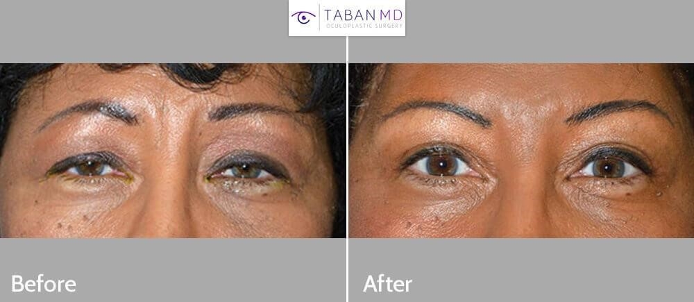 rhinoplasty surgeons near me