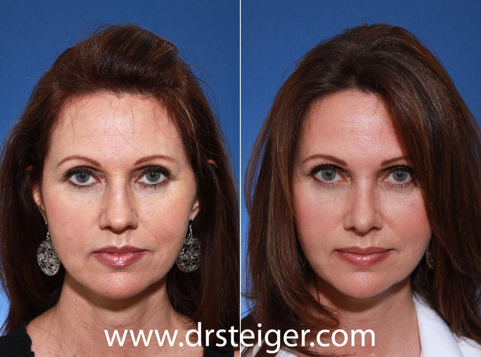 rhinoplasty surgeons near me