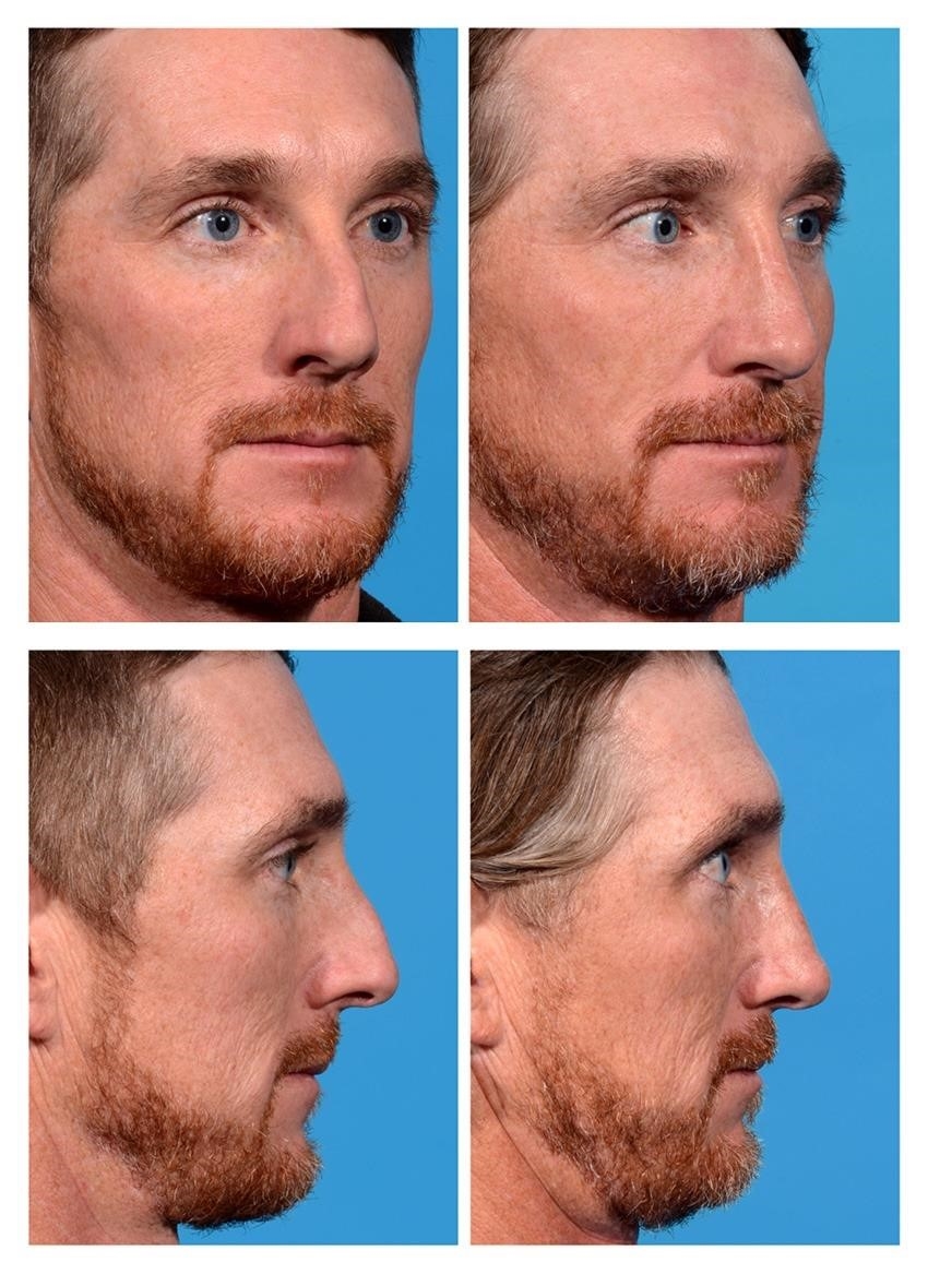 rhinoplasty surgeons near me